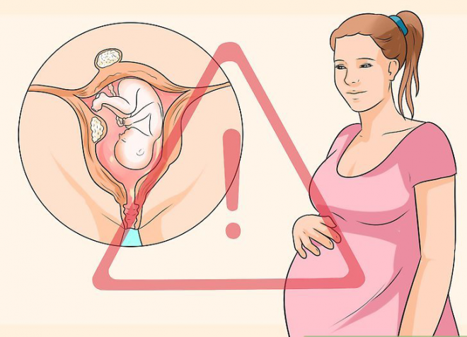 U xơ tử cung khi mang bầu